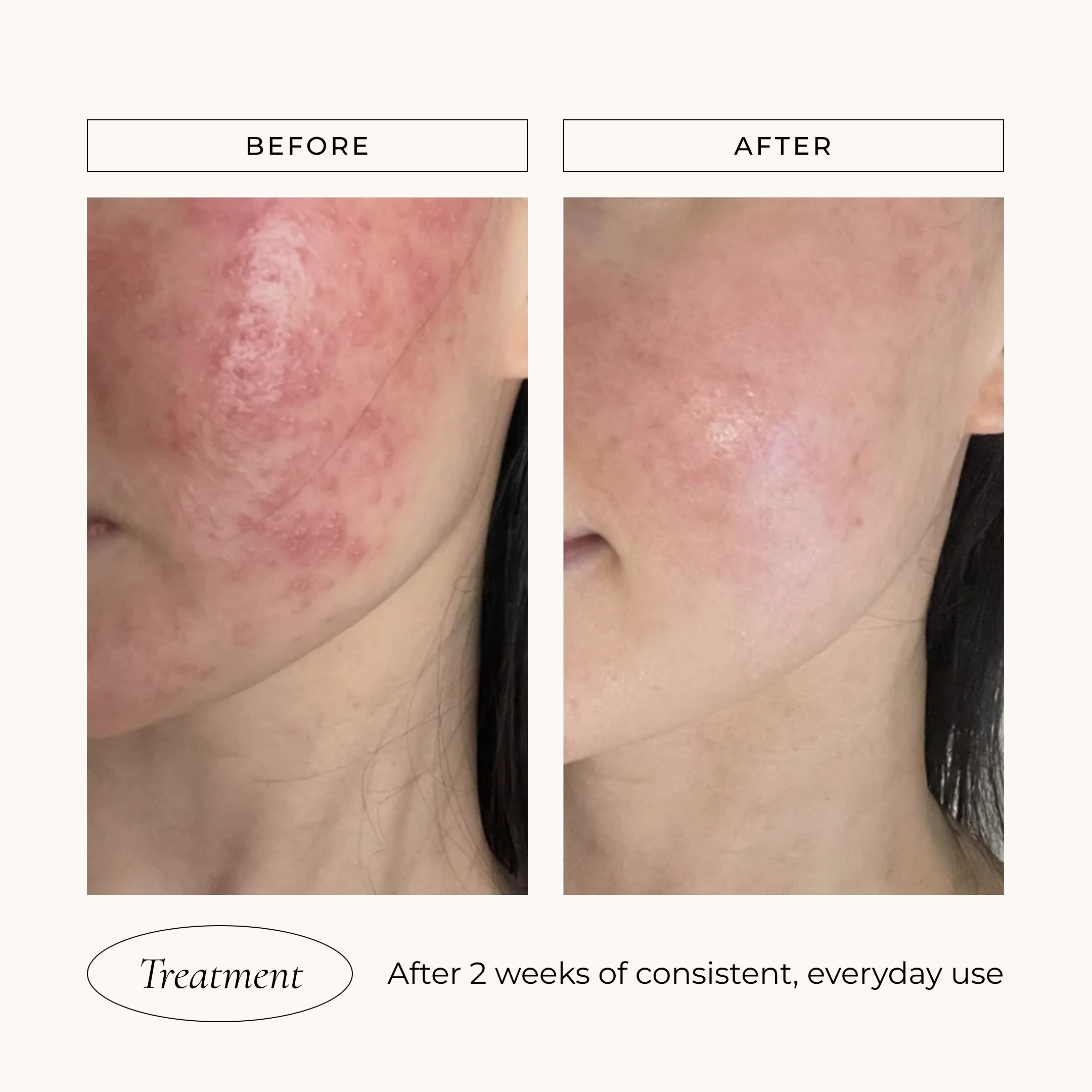 Iso-Cell Recovery Solution